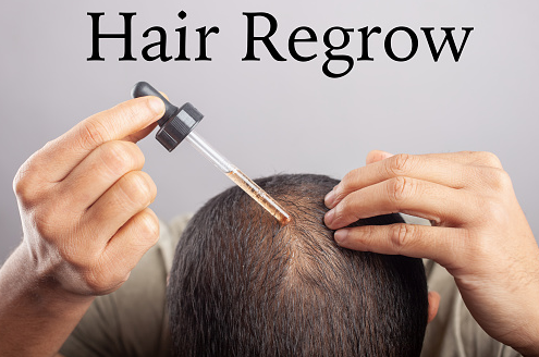 How Using Minoxidil Daily Can Help You Stop Hair Loss & Regrow Your Hair