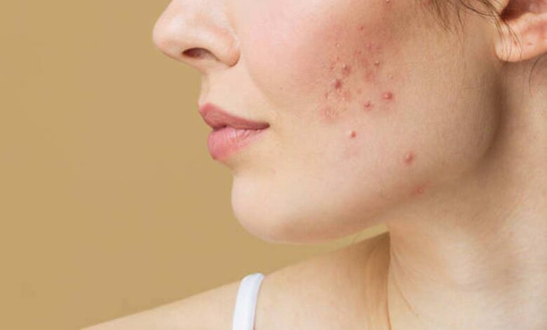 Looking for a Pimple Scar Cream? Here’s What Dermatologists Recommend