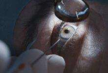 Why Sunglasses Are Essential After Cataract Surgery