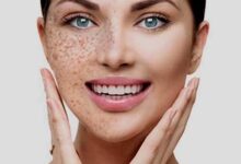 Pigmentation Removal at Home: Natural Remedies That Work