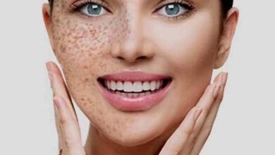 Pigmentation Removal at Home: Natural Remedies That Work