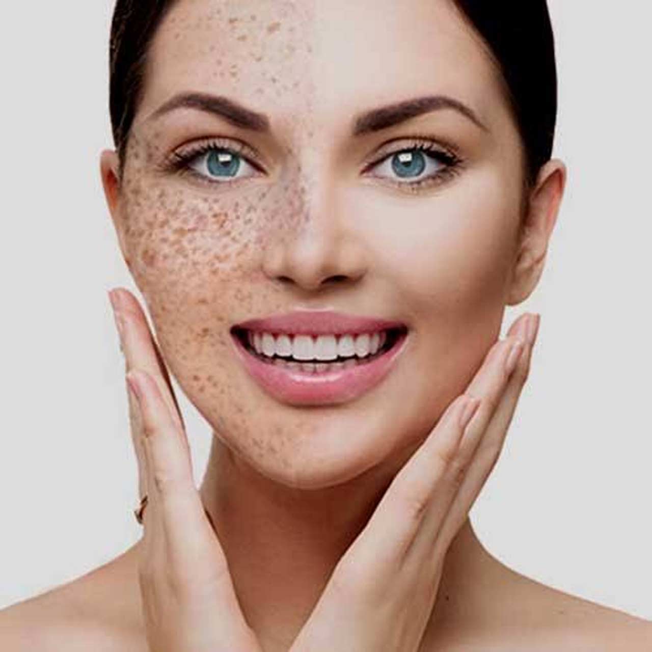 Pigmentation Removal at Home: Natural Remedies That Work